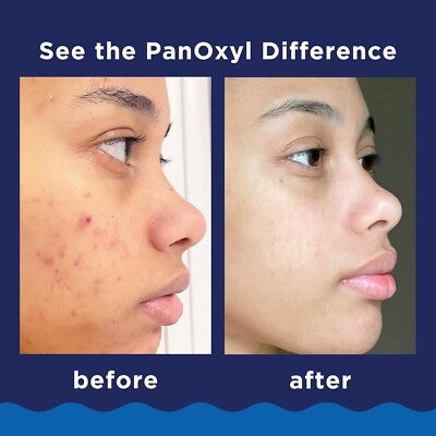 PanOxyl Creamy Face Wash with 4% Benzoyl Peroxide
